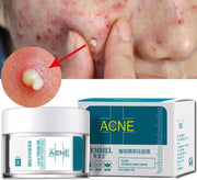 Acne Cream – Clear Skin & Pimple Treatment