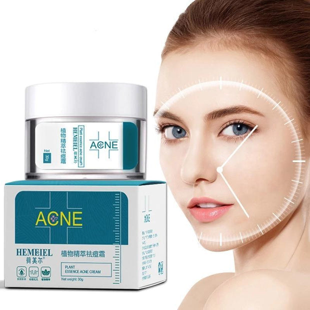 Acne Cream – Clear Skin & Pimple Treatment